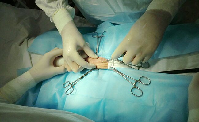 Η χειρουργική επέμβαση στο αναπαραγωγικό όργανο θα βοηθήσει στην αύξηση του μεγέθους του